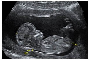 Screening nuchal translucency what is Nuchal translucency