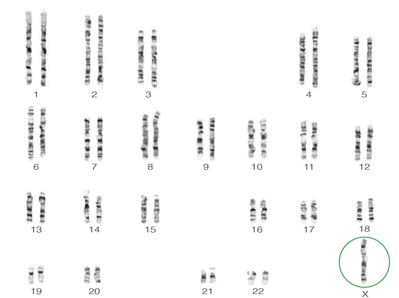 Caryotype de la Monosomie X (45,X)