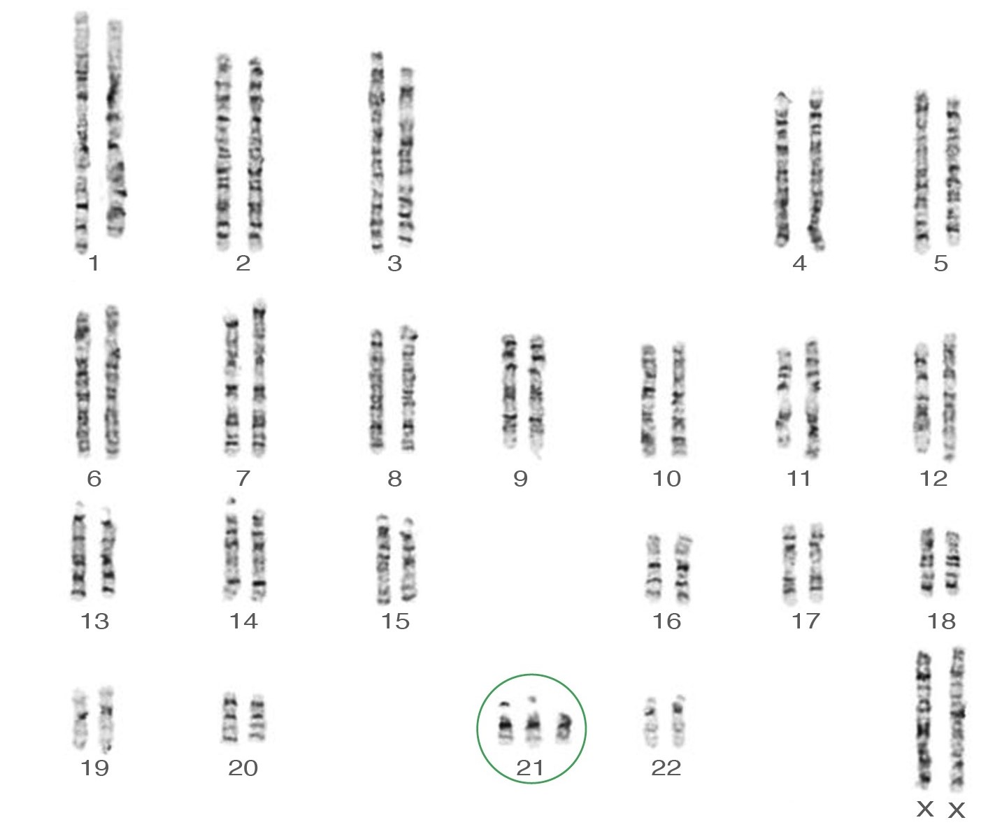 Trisomy 21