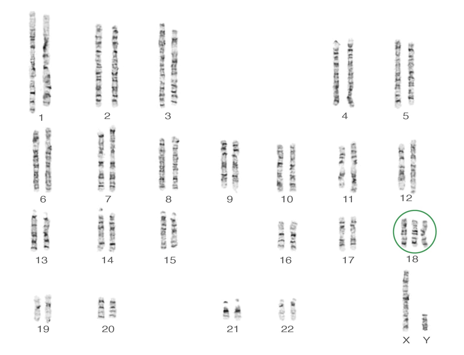 Trisomy 18 karyotype