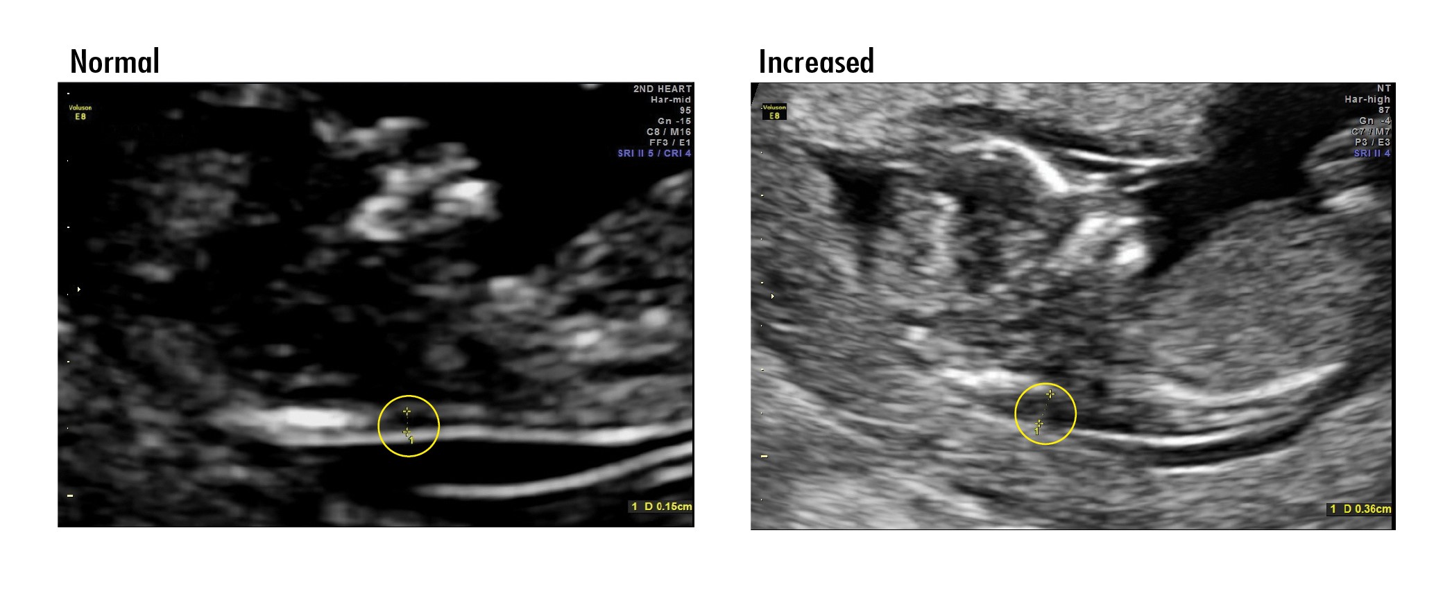 Nuchal translucency ultrasound result