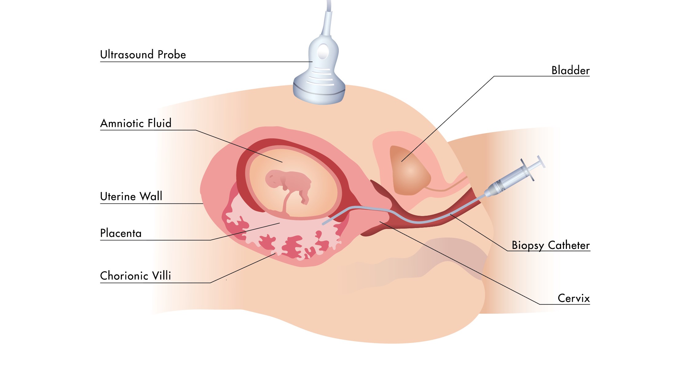 Transcervical CVS