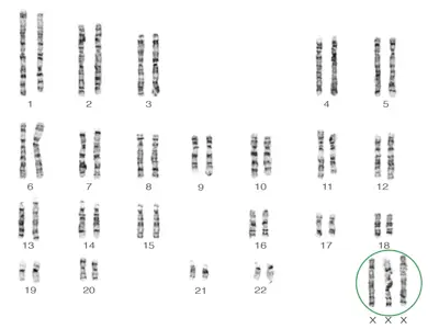 47,XXX karyotype