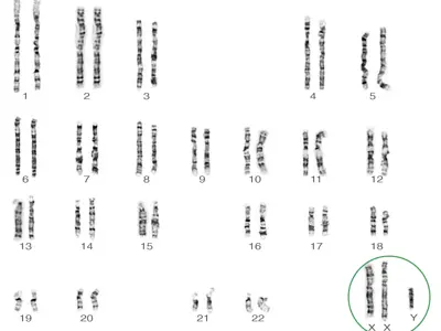 Klinefelter syndrome karyotype