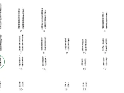 Trisomy 13 karyotype