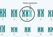Trisomy 13 karyotype