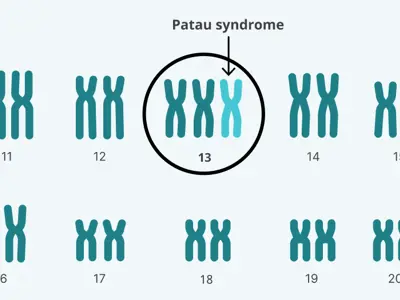 Trisomy 13 karyotype